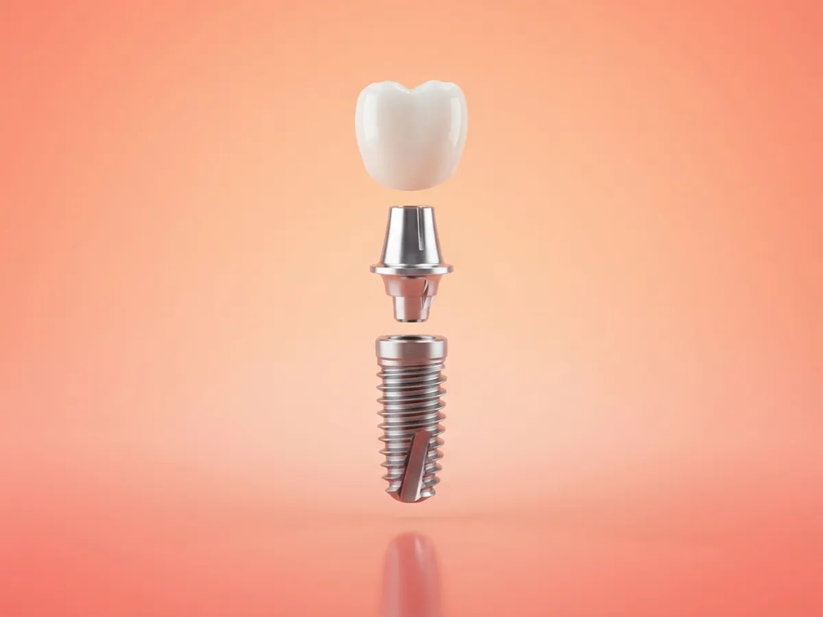 İmplant dişin ayrık 3D çizimi: altta titanyum implant vidası, ortada abutment, üstte seramik kron