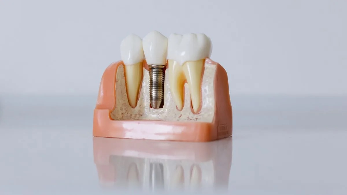 Çene kemiğine yerleşen titanyum diş implantı kesit modeli