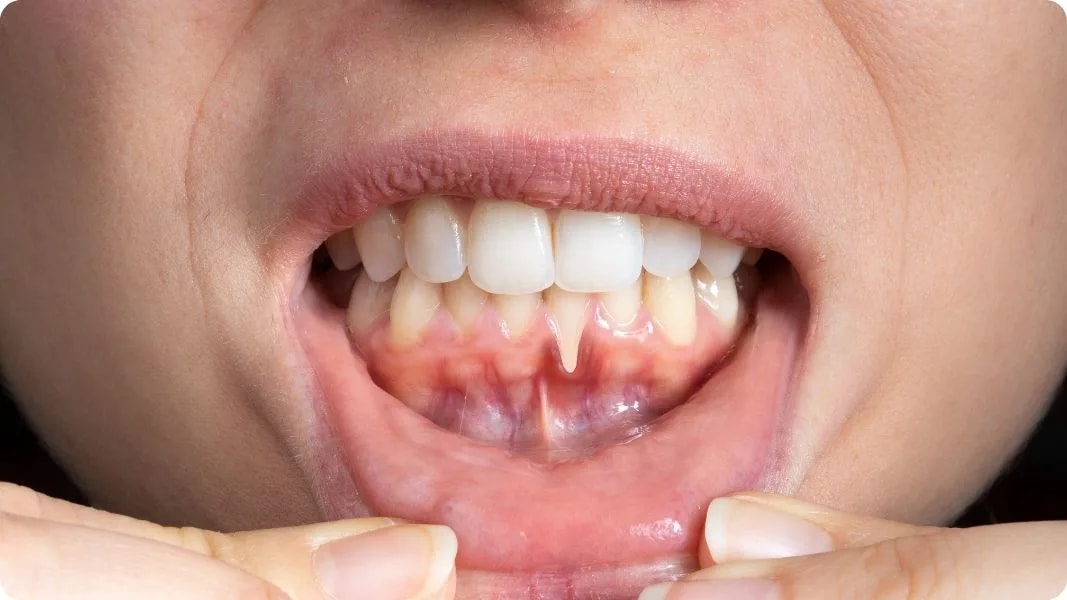 Periodontal hastalık nedir – Dişeti Hastalıkları