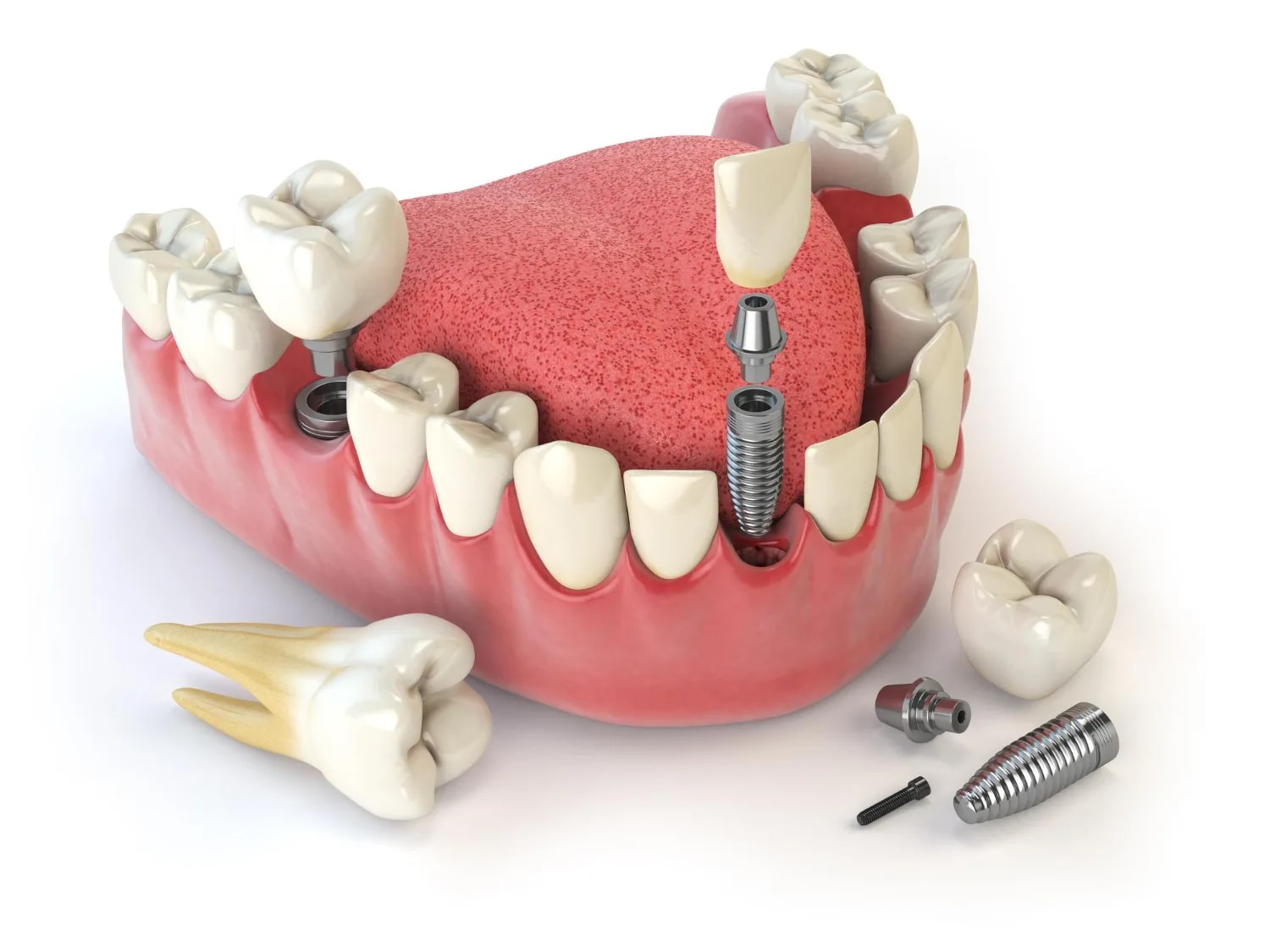 Güçlü Gülüşünüz İçin Yeni Bir Başlangıç Implant Tedavisi