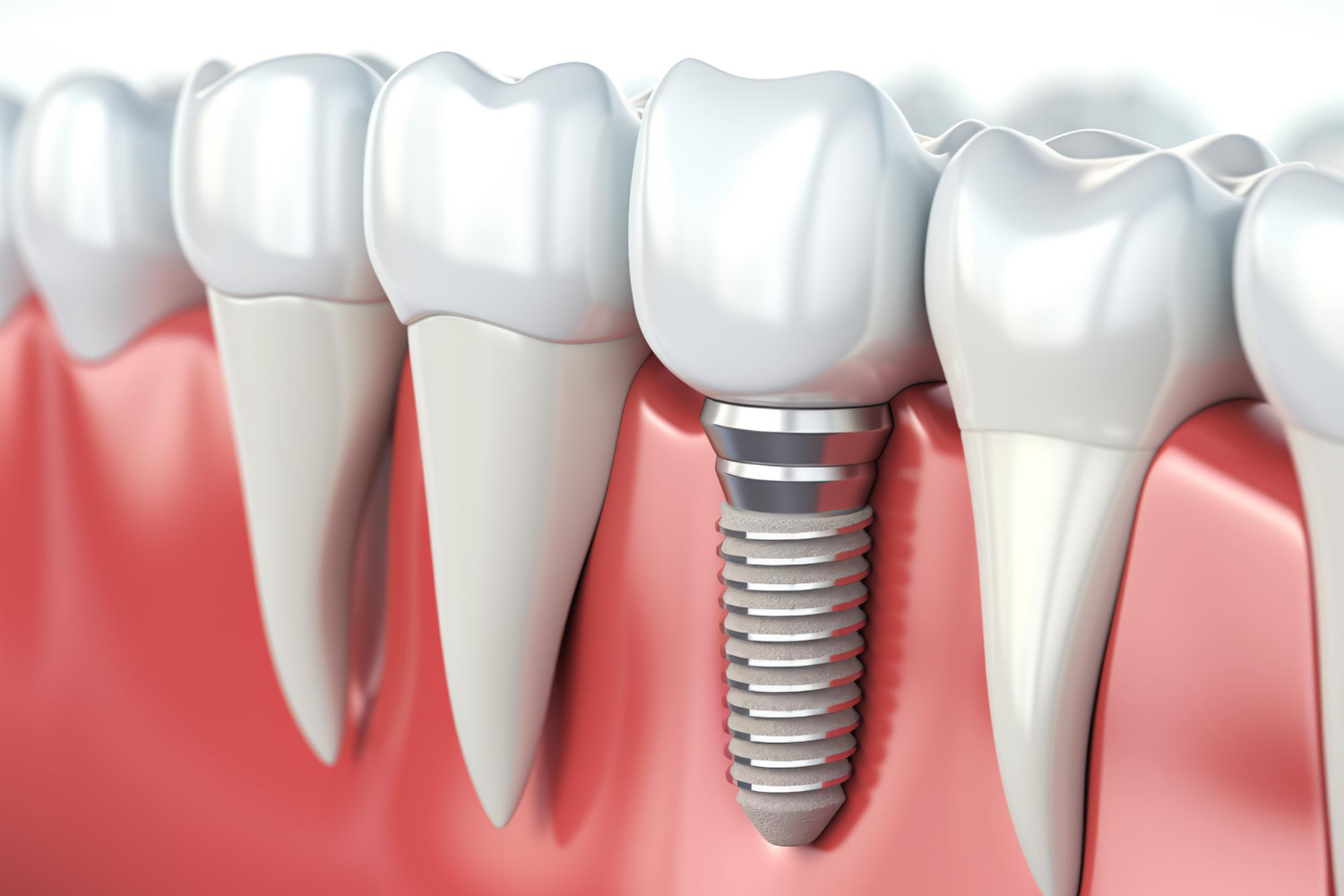 Dental implant