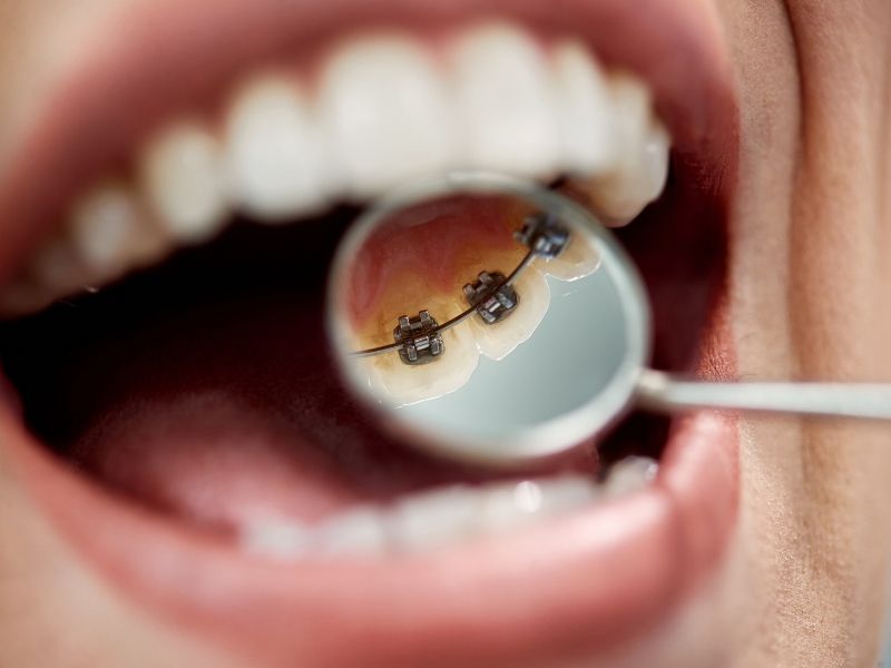 Lingual Ortodonti